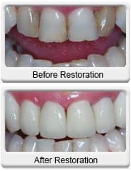 Chandler Cosmetic Dentist - All Ceramic Crowns - before and after
