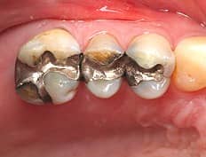 dental composites before restoration
