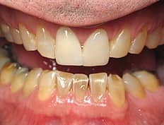 dental crowns veneers before