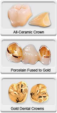 Dental Crowns - All Ceramic, Porcelain Fused to Gold, Gold Dental Crowns