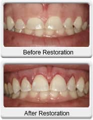 dental gum reduction before after