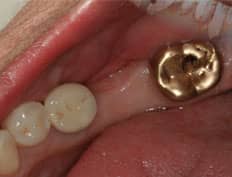 dental implant before placement