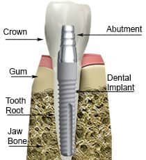 Dental implant tooth illustration