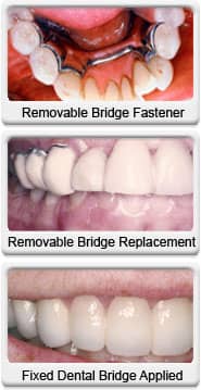 fixed dental bridge before after