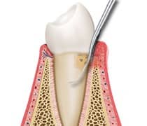 periodontal dentistry dental scaling