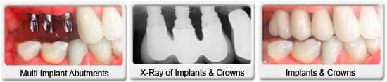 Chandler dentist - Ocotillo Dental Care - multiple Dental Implant