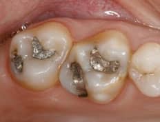 Tooth Colored White Fillings before amalgam removal
